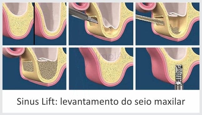 Enxerto ósseo levantamento do seio maxilar sinus lift Implante