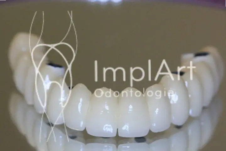 Implante Para Arcada Completa Ou Sem Gengiva ImplArt Implantes