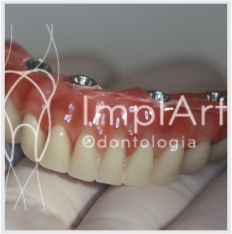 protocolo resina Implante Dentário e Prótese Dentária ImplArt