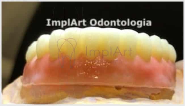 Protese Fixa De Zirconia Estetica Translucidez 50kb ImplArt