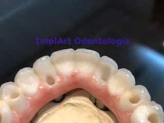 Protocolo De Zirconia Dentaria Implart