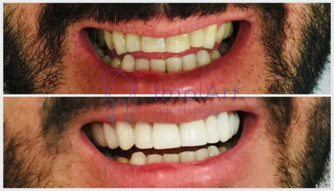 Lente De Contato Dental Antes E Depois 50kb ImplArt