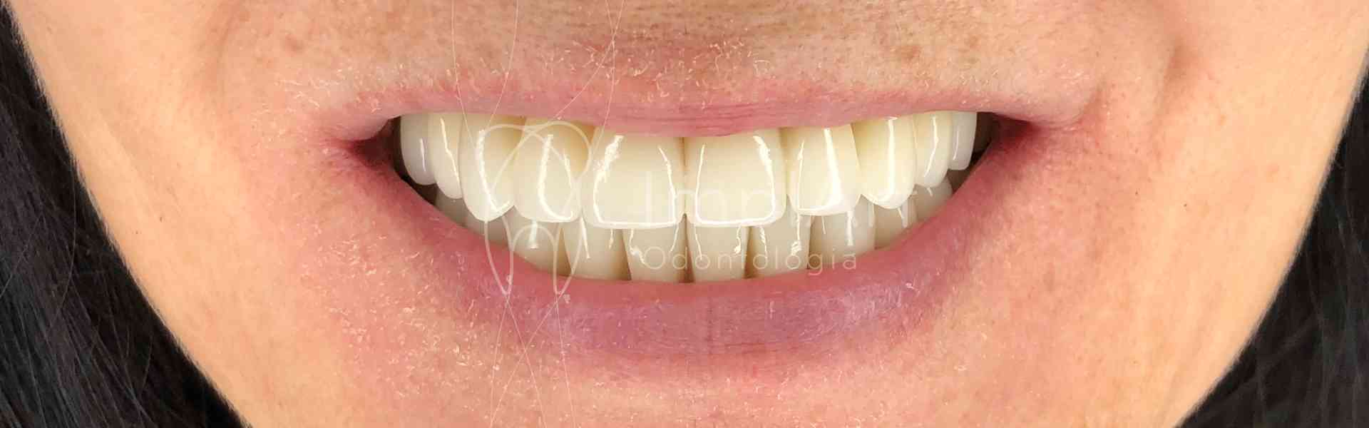 Protese Dentaria Fixa Em Zirconia Dental Kb Implart