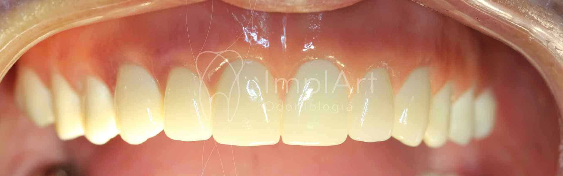 Protese Dentaria Fixa Em Zirconia Dental 48kb ImplArt