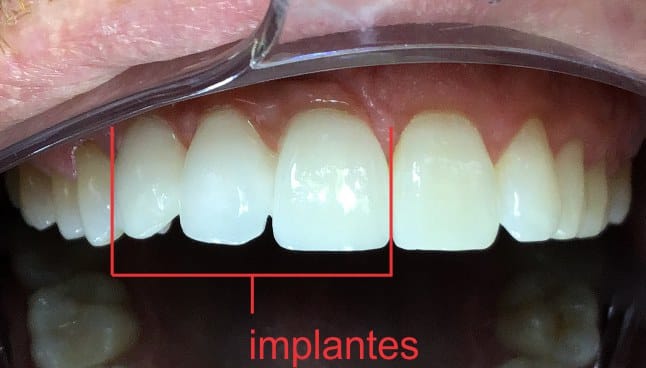 Implantes Zirconia Kb Implart