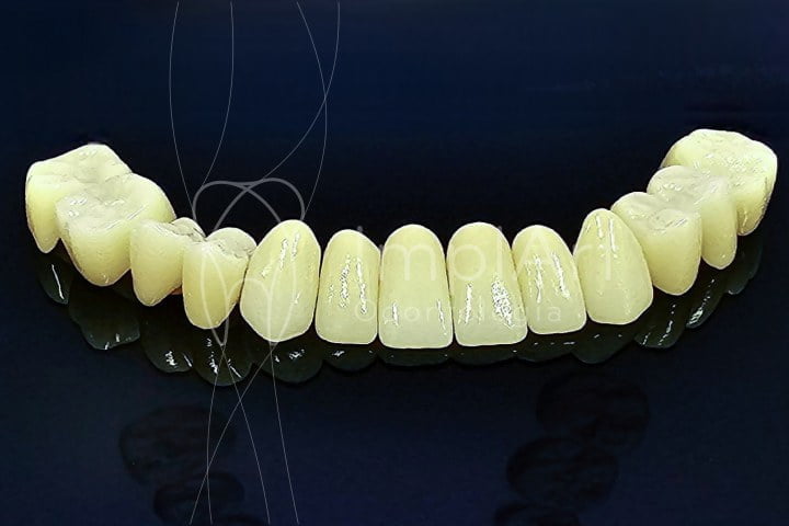 Coroas De Zirconia Pura Kb Implart