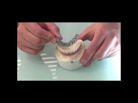 Implante Dentário de Todos os Dentes | Materiais utilizados para prótese protocolo - implante total