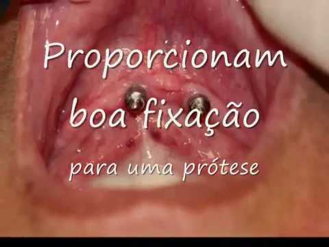 Como funciona uma overdenture com implante dentário - Prótese móvel com implantes dentários