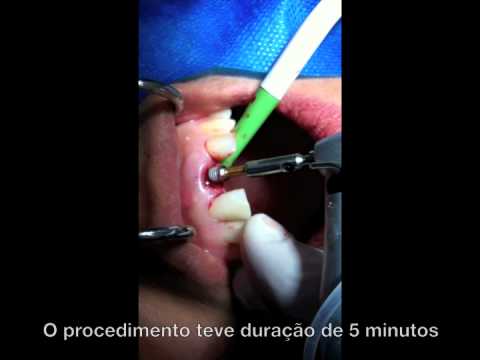 Implante Imediato Rápido - Implante Dentário na hora da extração | São Paulo-SP