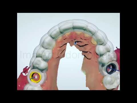 Cirurgia de Implante Dentário Guiada por Computador - Clinica ImplArt