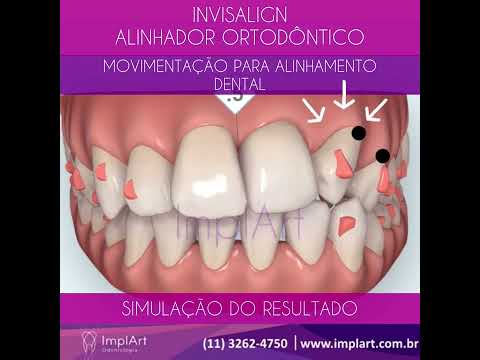 APARELHO INVISALIGN VEJA A MOVIMENTAÇÃO PLANEJADA DOS DENTES