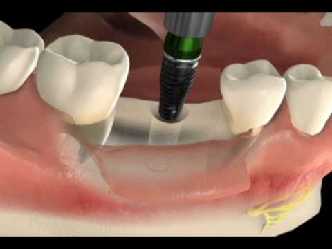 Como é a cirurgia de implante dentário - dente unitário - Clínica em São Paulo - SP