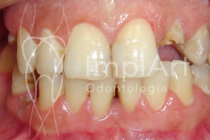 fratura dental o que fazer 50kb 049faa59