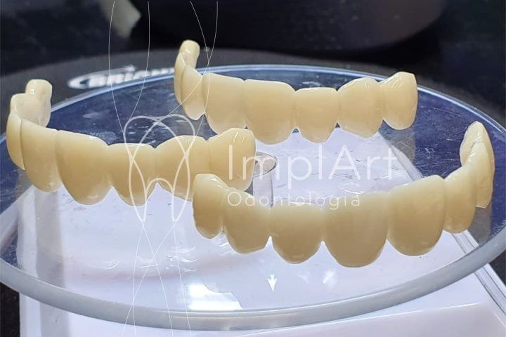 dentes provisorios impressos 3D 50kb 0d5156ab