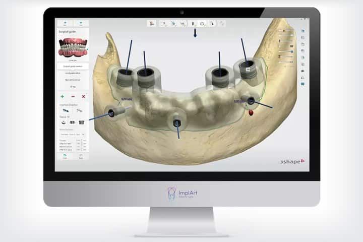 implante cirurgia guiada total 50kb 0e438105