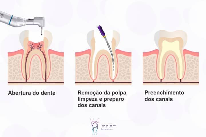 tratamento de canal 49kb 1379117b