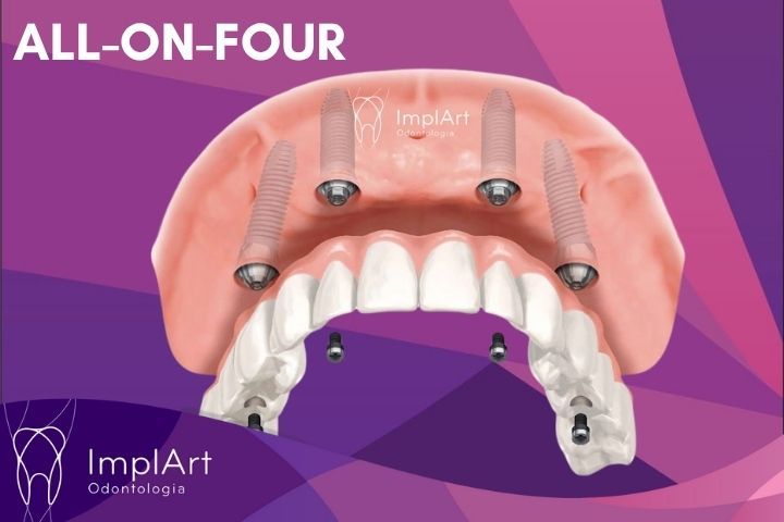All on four or All on 4 implant technique aLL-ON-FOUR