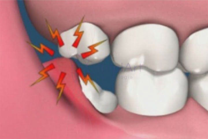 pericoronarite dente siso inflamado 50kb 2294660f