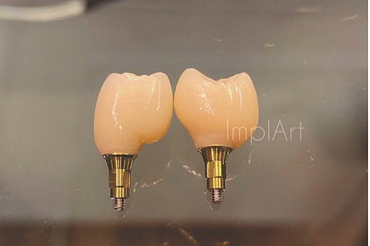 coroa aparafusada zirconia teste 2e99d651