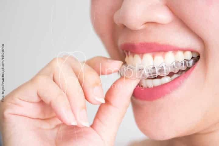 invisalign alinhador transparente invisivel 50kb 3127ffa3