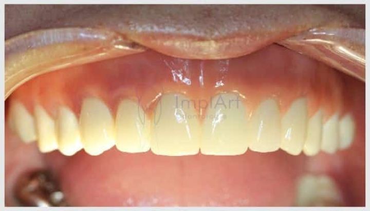 protese total zirconia 45kb 3a37839c