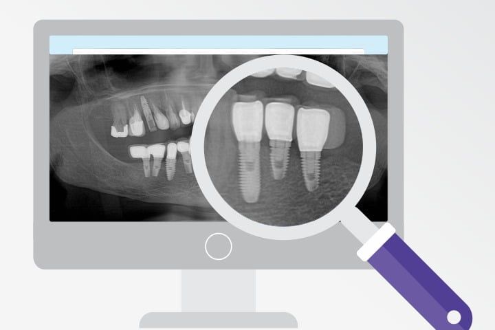 identificacao implantes dentarios 50kb 41750037