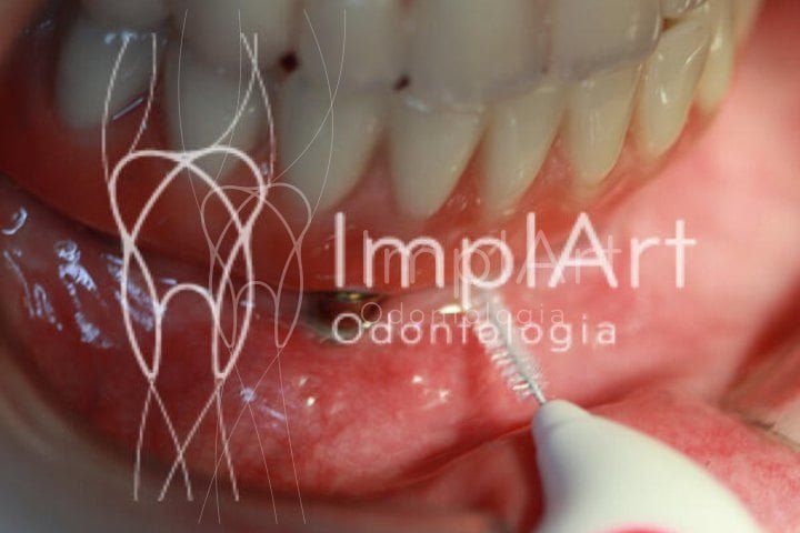 limpeza protese protocolo escova unitufo 50kb 49406825