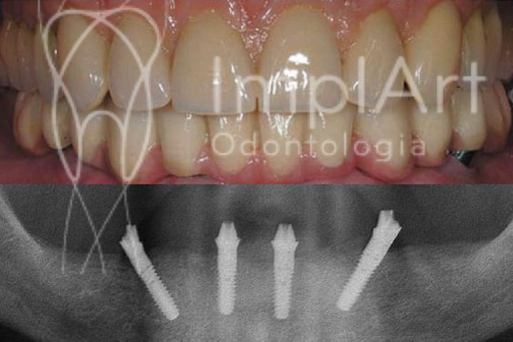 implantes dentarios all on four