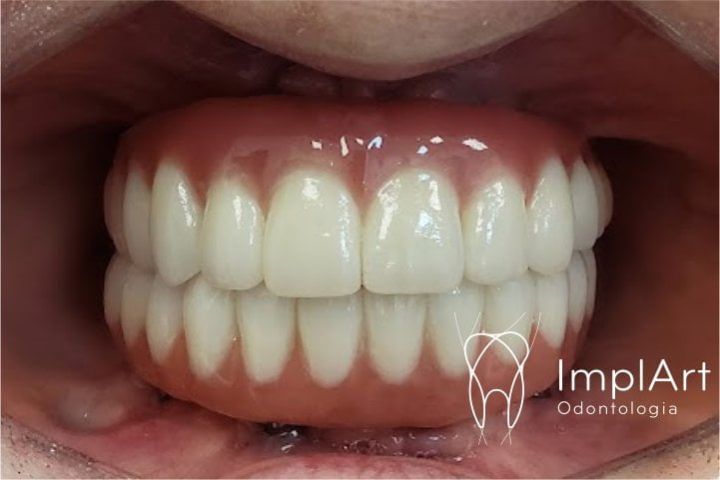 PROTESE PROTOCOLO ZIRCONIA SUPERIOR E INFERIOR SITE 5109f5e9