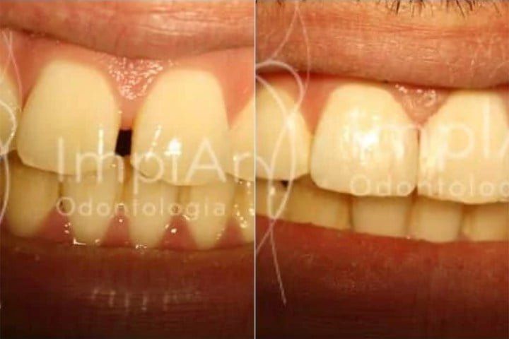 fechamento diastema resina 50kb 5f569b8e