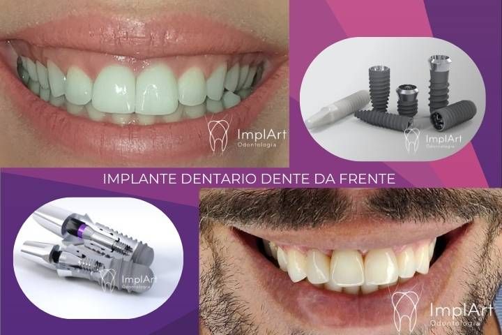 IMPLANTE DENTARIO DENTE DA FRENTE