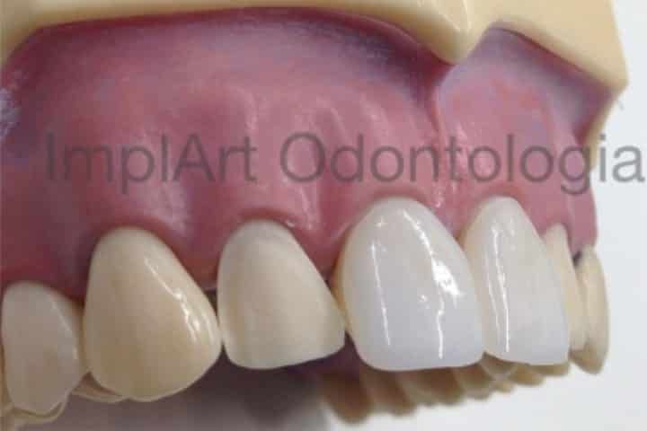 lente de contato dental 48kb 6c88b129