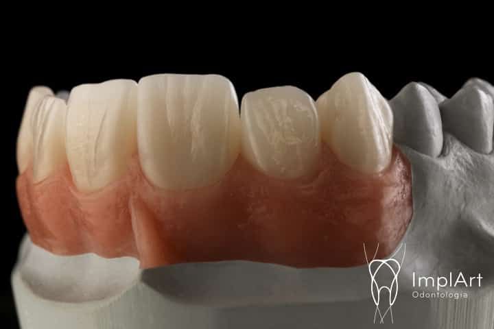 coroa de zirconia implante FX 46kb 7d74116e