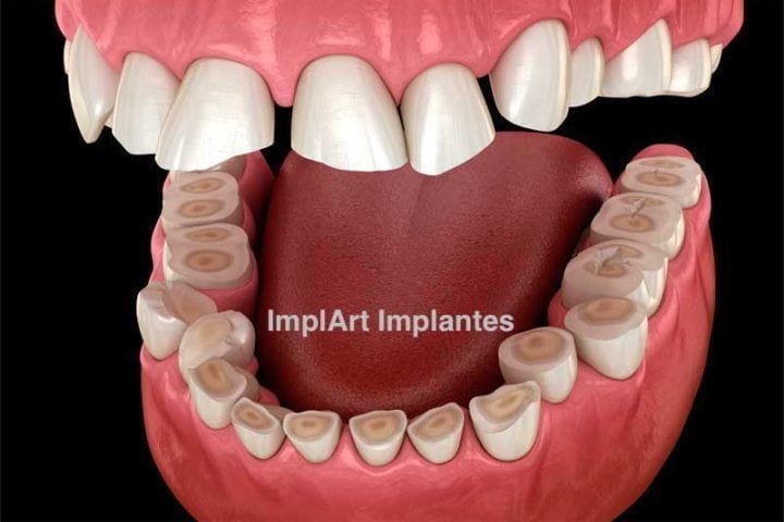 bruxismo dental 50kb 8094fcef