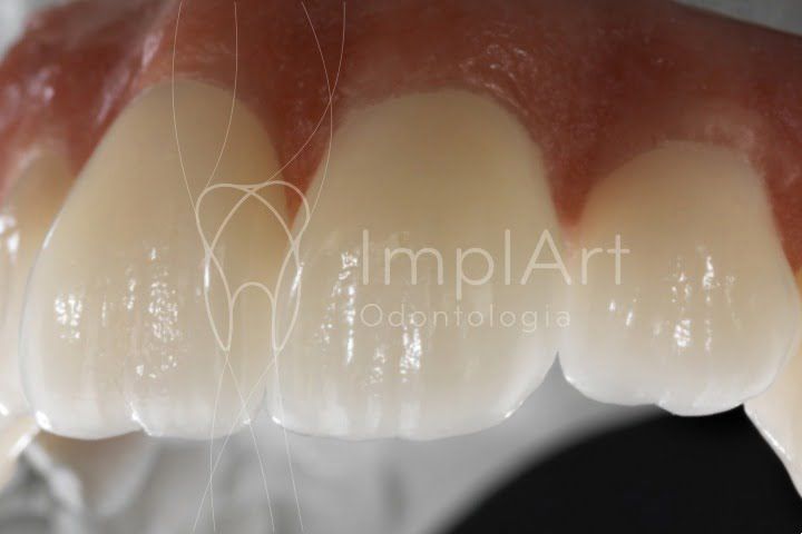 coroa zirconia pura 50kb 8afa5141