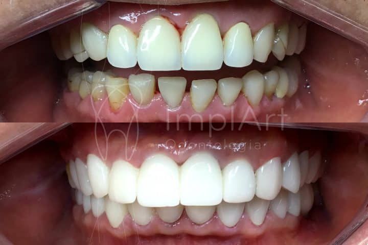 lente contato dental antes e depois 50kb 8a23f6d5