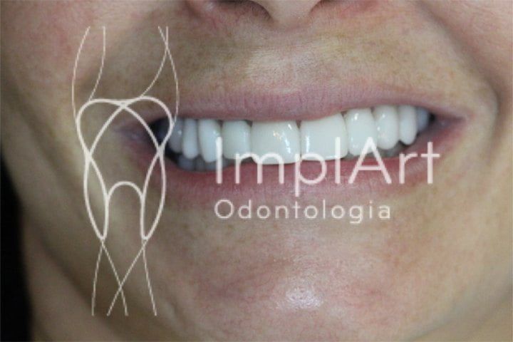 faceta em porcelana dental 50kb 933a0ef8