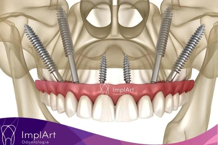 IMPLANTES ZIGOMATICOS