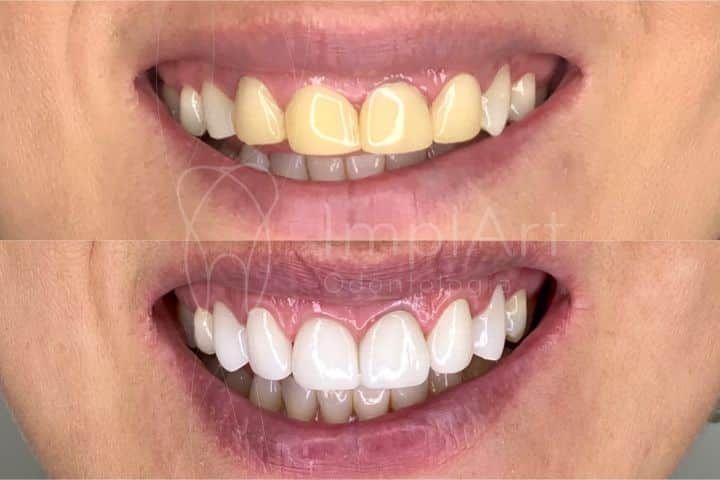 lentes de contato dental antes e depois 47kb 982f394b