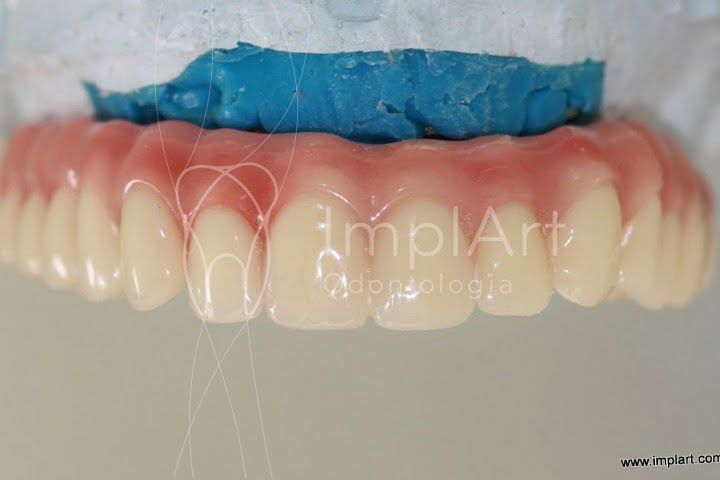 protese protocolo de resina 50kb 9ec2f811