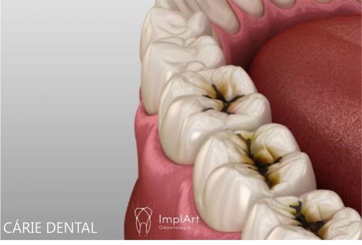 dente com buraco de carie SITE a2470ced