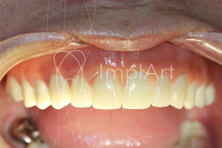 protese zirconia implart 50kb aed90632