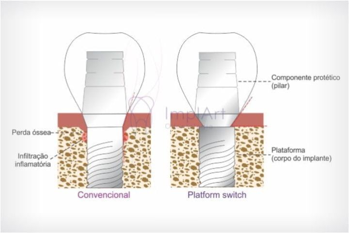 platform switch implants 50kb b1bba2de