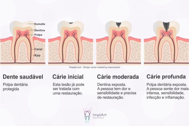 carie tratamento canal 50kb b307063a