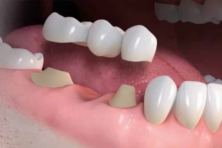 ponte sobre dentes fixa protese 50kb b938a63c