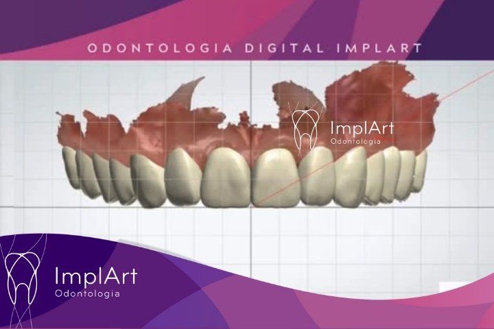 Technology: metal free prostheses made by computer and AI Odontologia digital