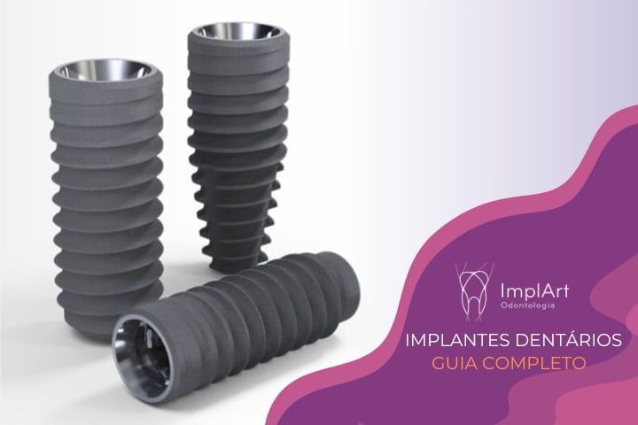 implantes dentarios