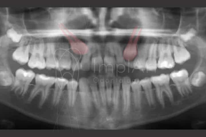 dentes impactados retidos 50kb c7232d30