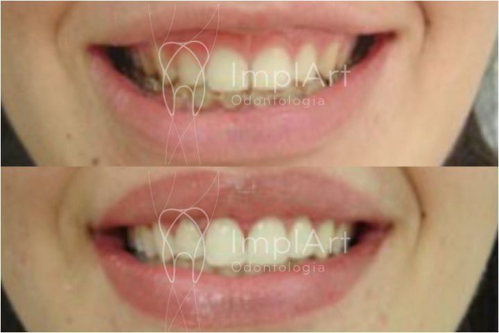 sorriso gengival tratamento antes e depois 50kb c75b920a