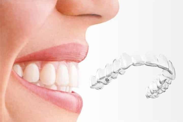 invisalign alinhador transparente invisivel 49kb cb279ca5